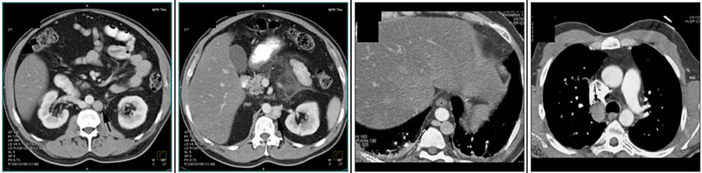 Anatomic variant:Azygos continuation of the IVC